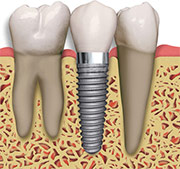 Diagram showing a Dental Implant