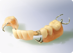 Traditional partial denture